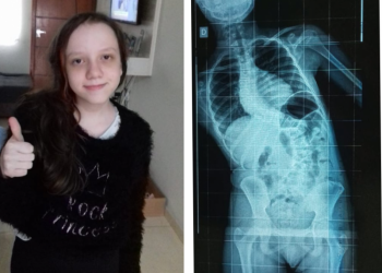 Menina de São João Batista precisa de R$ 180 mil para cirurgia urgente