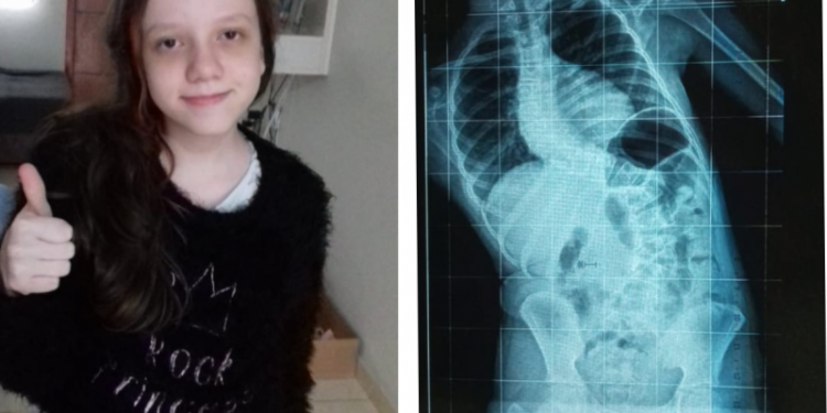 Menina de São João Batista precisa de R$ 180 mil para cirurgia urgente