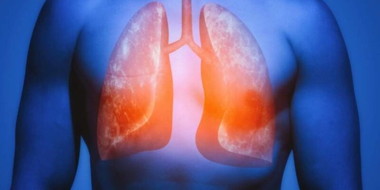 Nova vacina contra o câncer de pulmão demonstra um resultado sem precedentes, reduzindo em 41% o risco de mortalidade em pacientes