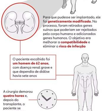 Cirurgia histórica: Médico brasileiro lidera inédito transplante de rim suíno para paciente humano nos Estados Unidos