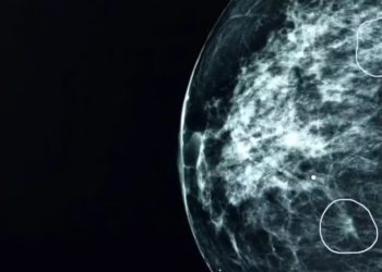 IA traz novas perspectivas para o tratamento precoce do câncer