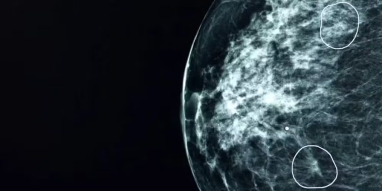 IA traz novas perspectivas para o tratamento precoce do câncer