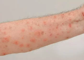 Vigilância em Saúde de Tijucas intensifica medidas de prevenção após surto de sarna humana na região