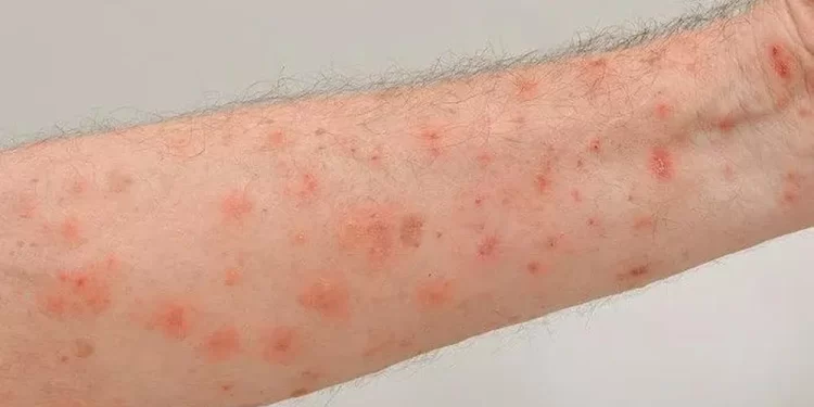 Vigilância em Saúde de Tijucas intensifica medidas de prevenção após surto de sarna humana na região