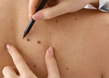 Santa Catarina lidera risco de câncer de pele no Sul do Brasil