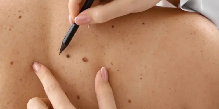 Santa Catarina lidera risco de câncer de pele no Sul do Brasil