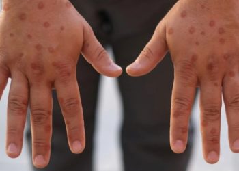 Casos de mpox no Brasil chegam a 140 em 2026, aponta Ministério da Saúde