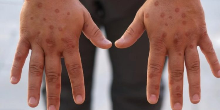 Casos de mpox no Brasil chegam a 140 em 2026, aponta Ministério da Saúde